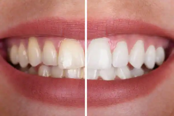 Teeth Whitening Before and After